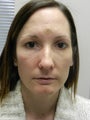 Before and After Skin Care