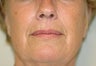 Before and Resurfacing Coblation Skin Resurfacing
