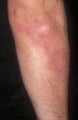 Psoriasis Treatment
