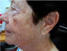 Fractional laser therapy