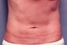 Slim Lipo