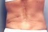 Slim Lipo