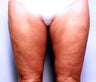 Slim Lipo