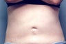 Slim Lipo