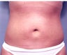 Slim Lipo