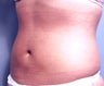 Slim Lipo