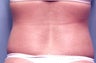 Slim Lipo
