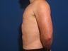 Slim Lipo