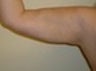 Slim Lipo on the arms