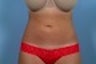 Slim Lipo on the abdomen