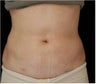 SlimLipo Abdomen Showing Skin Tightening