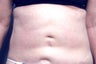 Slim Lipo