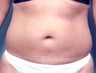 Slim Lipo