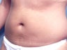 Slim Lipo