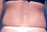 Slim Lipo