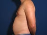 Slim Lipo
