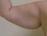 Slim Lipo on the arms