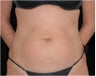 SlimLipo Abdomen Showing Skin Tightening