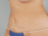 Smart Lipo