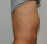 Smartlipo in Males