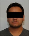 Smartlipo Neck