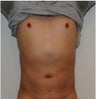 Smartlipo Abdomen