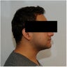 Smartlipo Neck