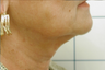 SmartLipo