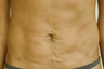 SmartLipo Abdomen
