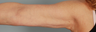 Smart Lipo