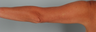 Smart Lipo Brachial