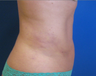 Smart Lipo