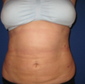 Smart Lipo