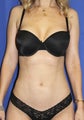 Laser-assisted Liposuction