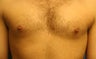 Smart-Lipo of the Chest, Liposuction, Gynecomastia