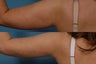 Smartlipo