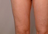 Smart Lipo-Liposuction