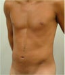 Laser Liposuction