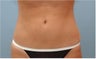 SmartLiposuction