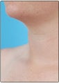 Smart Lipo, Neck Liposuction