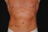 Smart Lipo Abs and Flanks