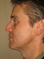 42 year old male before and after SmartLipo of the neck