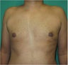 29 Year Old Male Treated for Gynecomastia with Smart Lipo Triplex