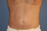 Smartlipo