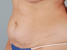 Smart Lipo
