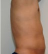 Smartlipo in Males