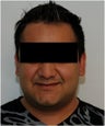 Smartlipo Neck