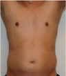 Smartlipo Abdomen