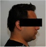 Smartlipo Neck
