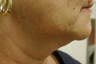 SmartLipo